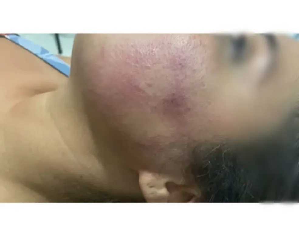 Mulher ficou com marca de mão no rosto após agressão em festa — Foto: Arquivo Pessoal